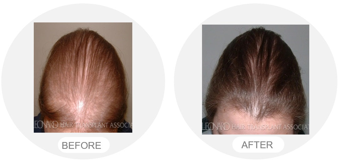 Capillus Japan 公式ストア|低出力レーザー育毛器|Capillus（カピラス）